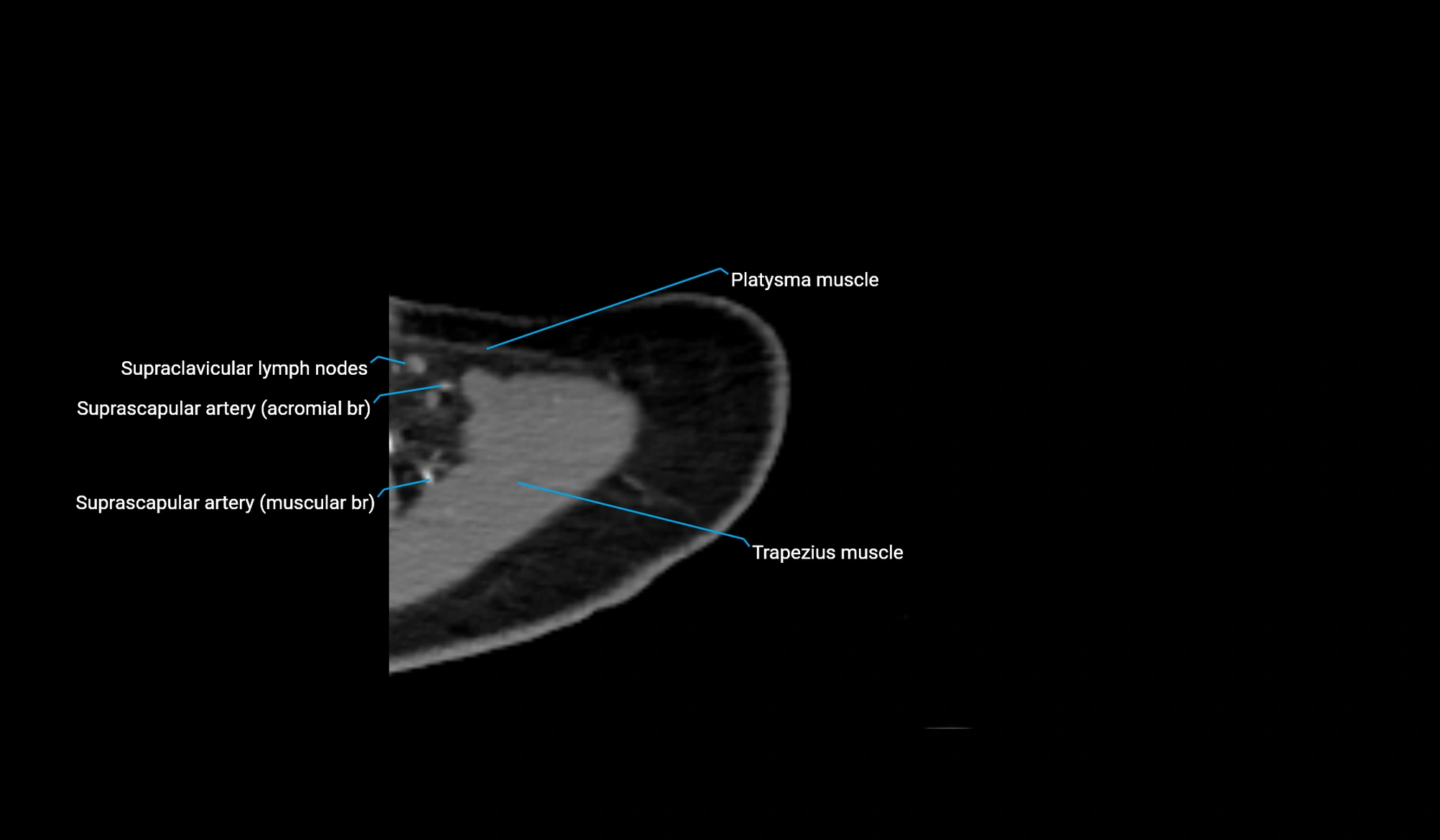 CT upper arm axial  cross sectional anatomy labelled radiology image -00046.webp